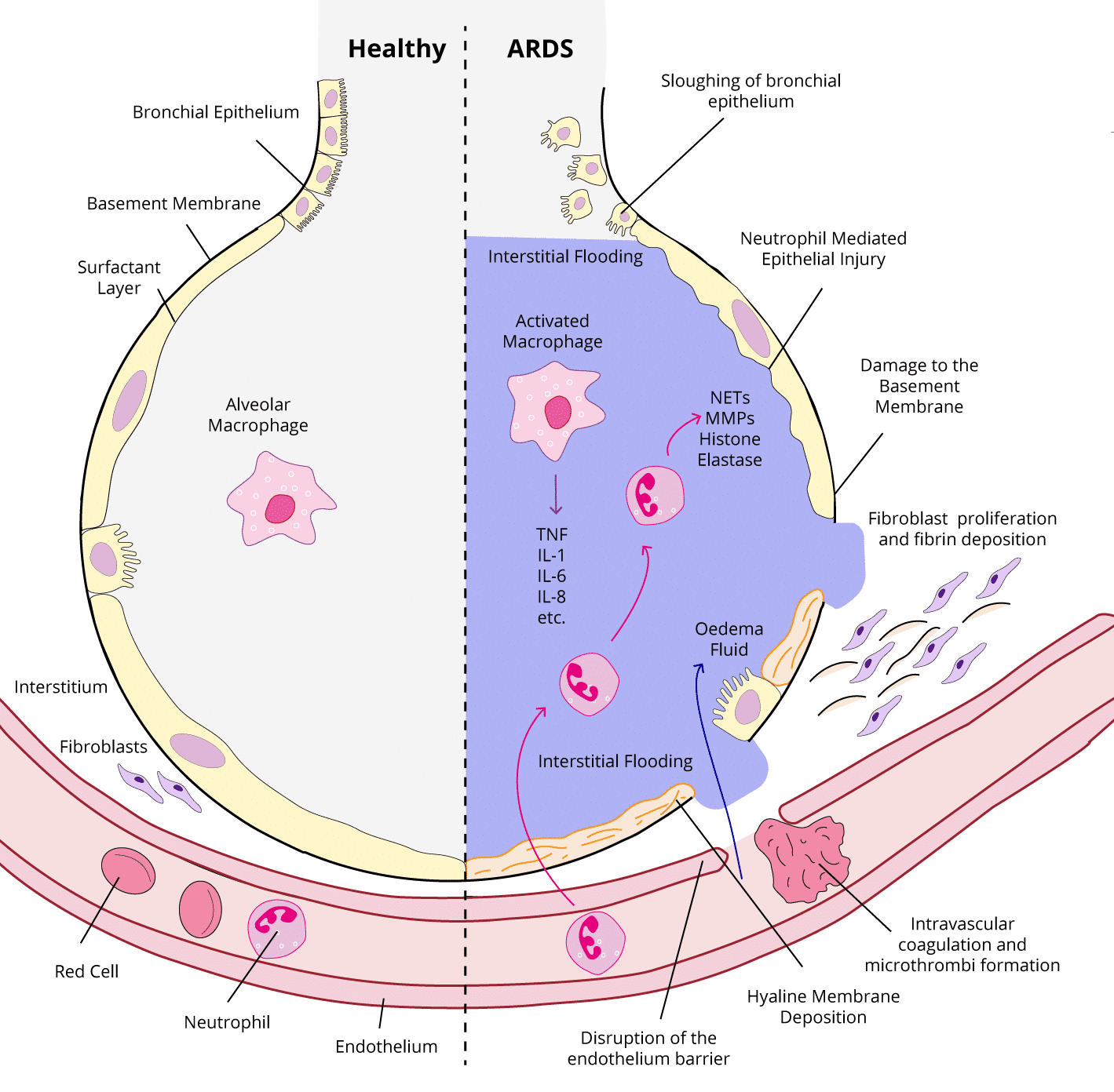 Pathophysiological mechanisms involved in ARDS