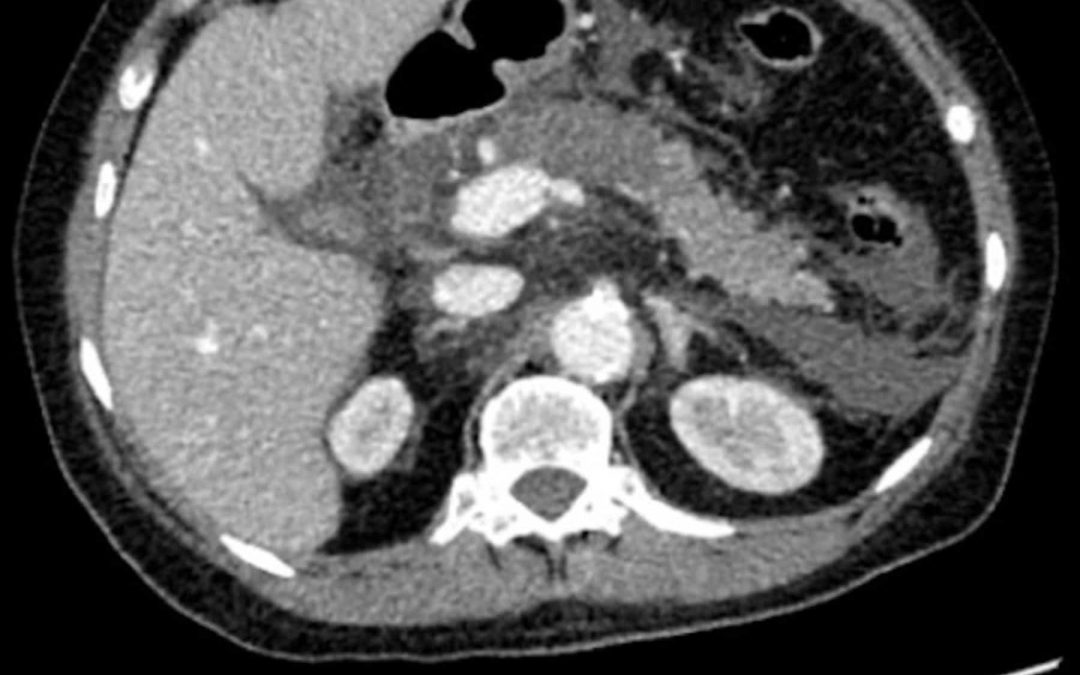 What abnormalities can you see on the CT scan and what is the likely diagnosis?