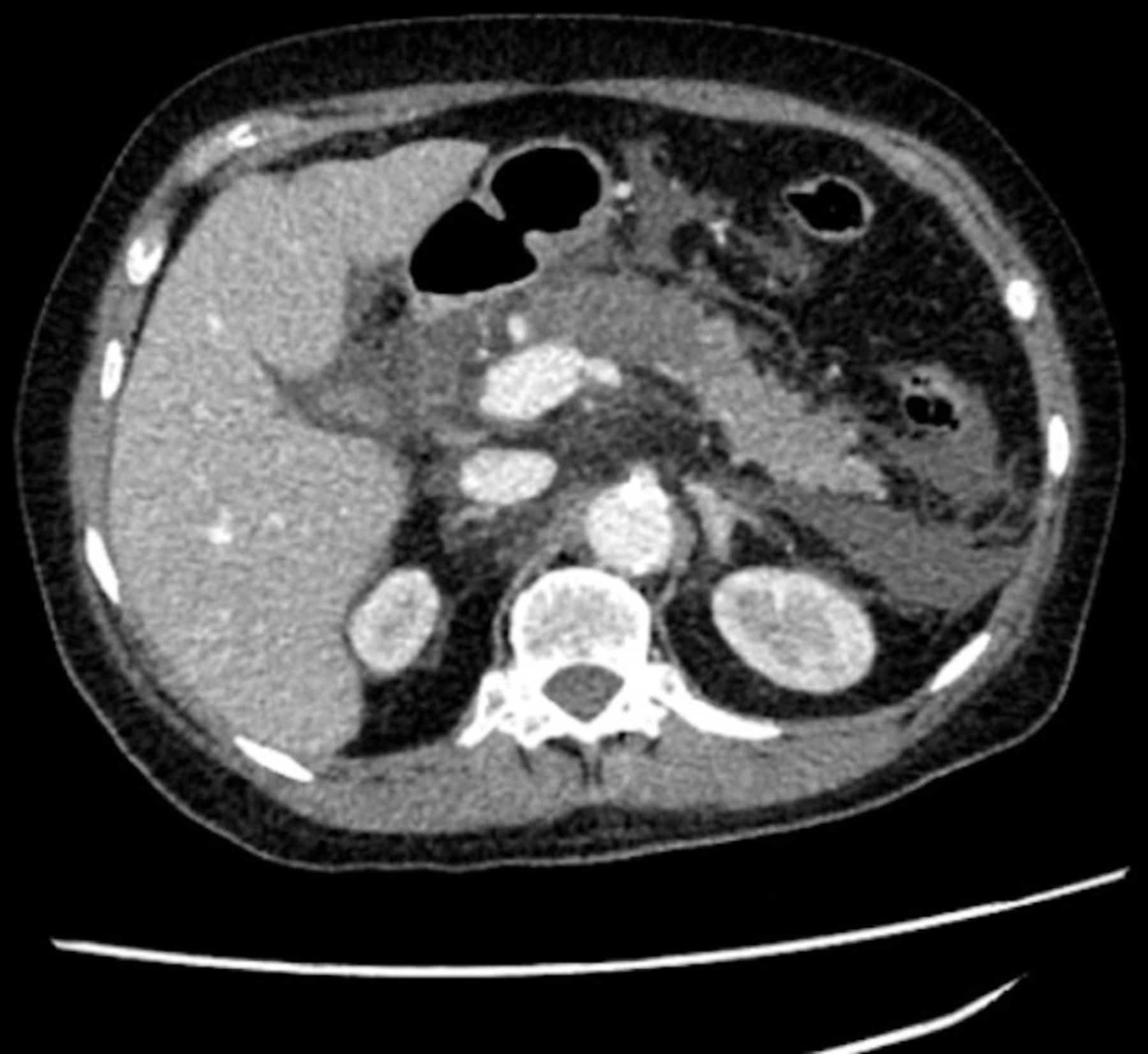 What abnormalities can you see on the CT scan and what is the likely diagnosis? theguidewire