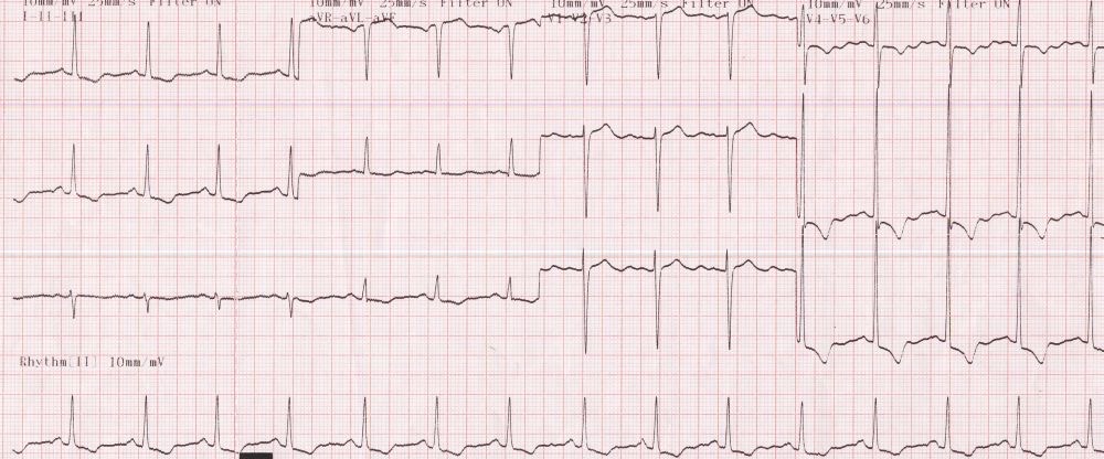 What is the cardiac axis on this ECG and which two leads is this easiest to determine from?