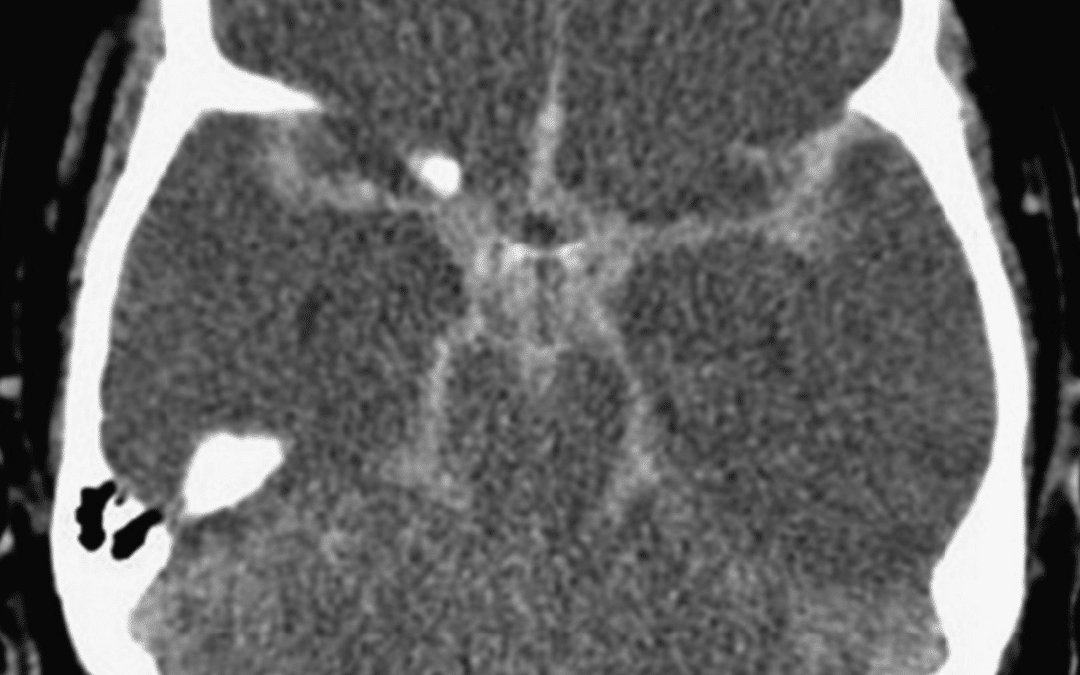 What does this CT scan show?