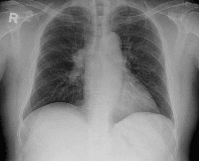What is the most obvious abnormality on the chest x-ray?