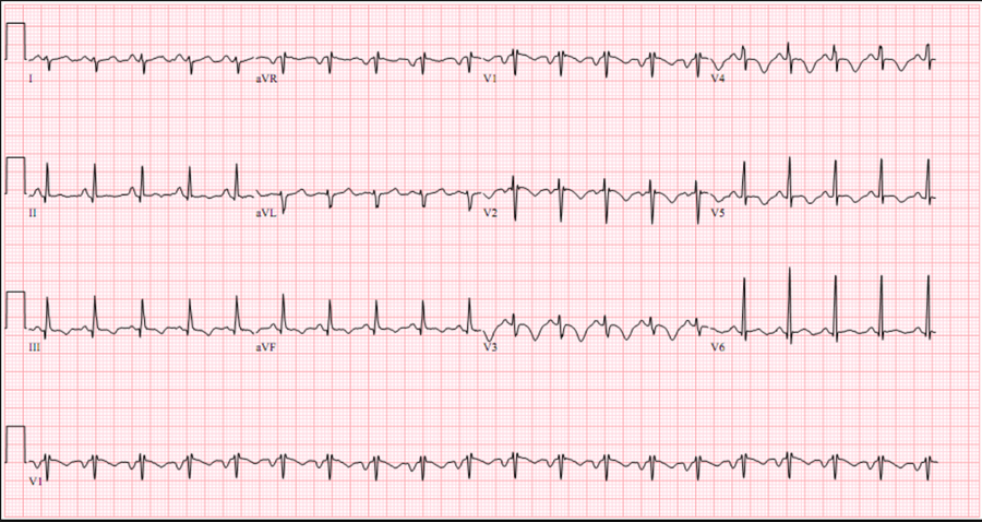 What does the ECG show?